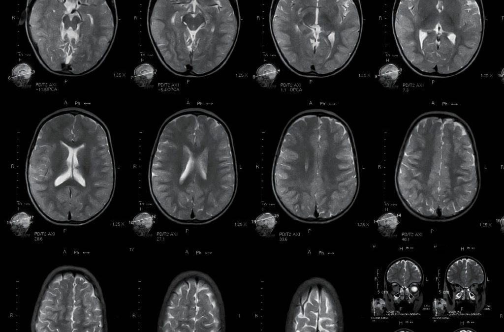 Professor Matilde Inglese – Imaging Multiple Sclerosis: Searching for Patterns in the Brain