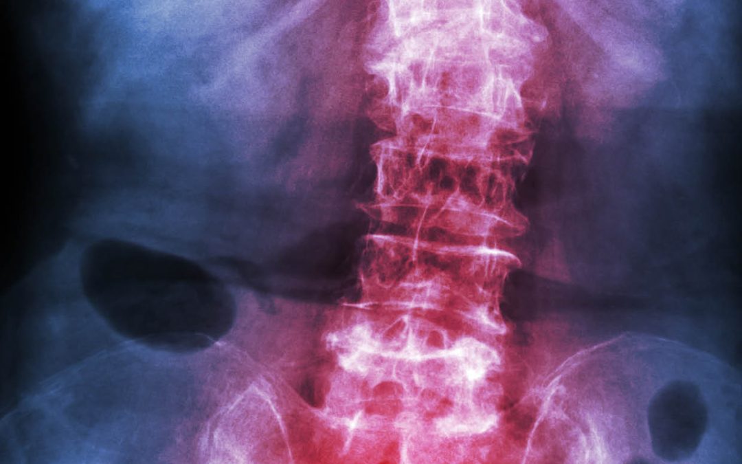 Dr Hans-Rudolf Weiss – Developing Innovative and Effective Non-surgical Therapies for Scoliosis