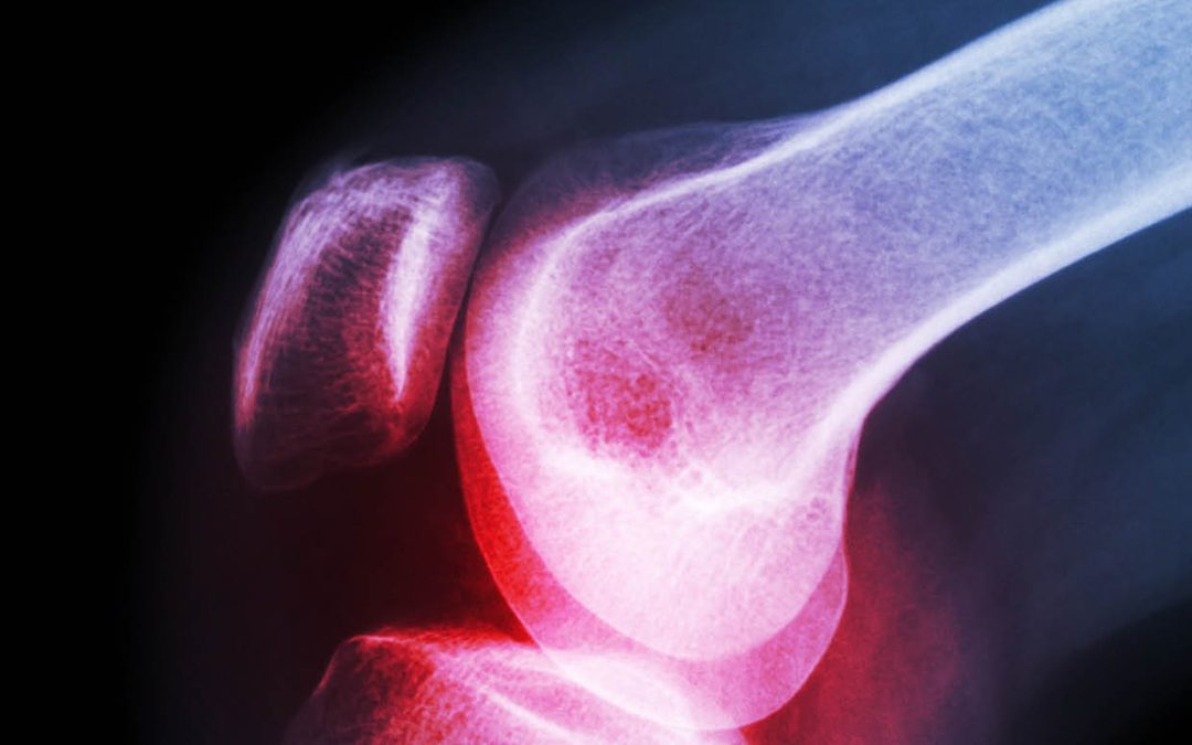 Dr Mario Zaiss – Dietary Fibre and the Prevention of Rheumatoid Arthritis