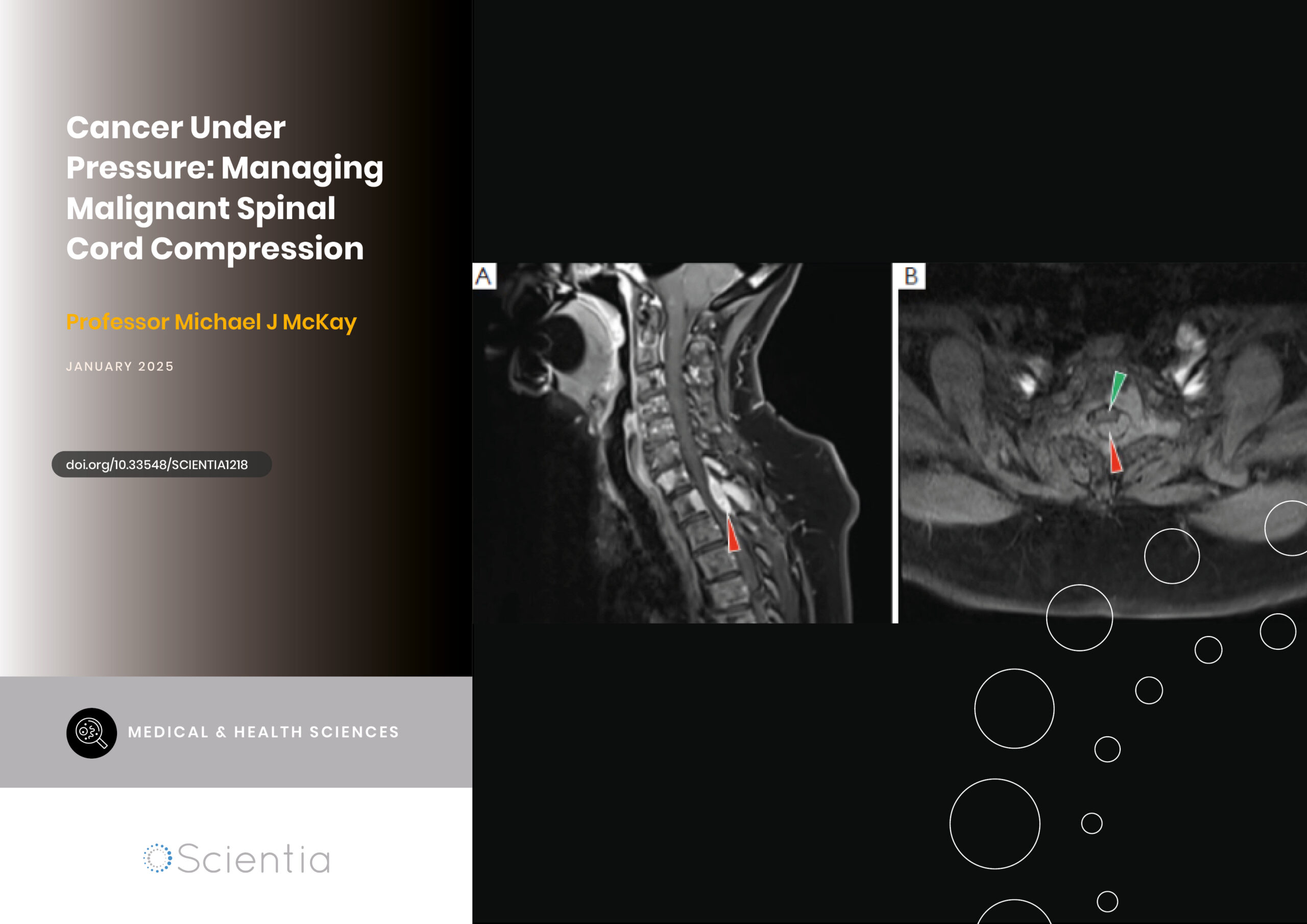 Cancer Under Pressure: Managing Malignant Spinal Cord Compression